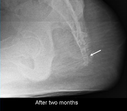 dislocation after two months.jpg
